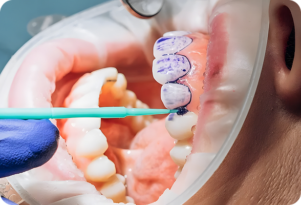 Close-up of dental procedure with dental tool applying blue marking on lower teeth inside a patient's mouth.