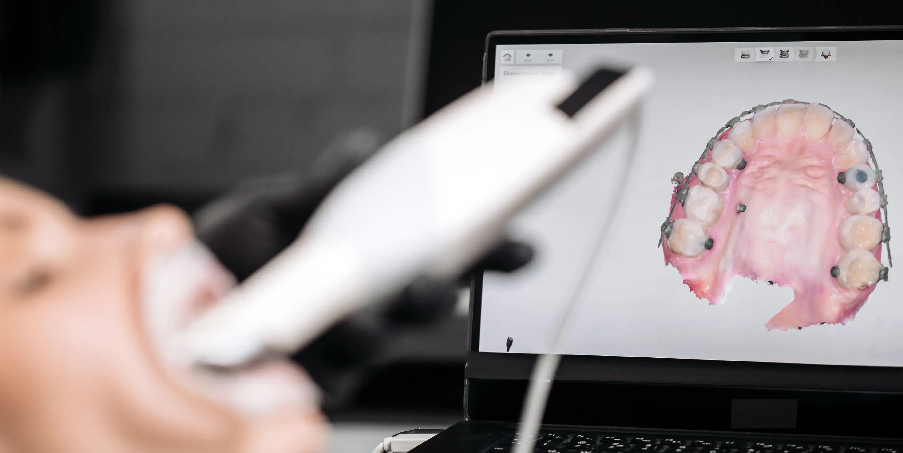 Digital dental scanner capturing a 3D image of a patient's upper teeth on a laptop screen.