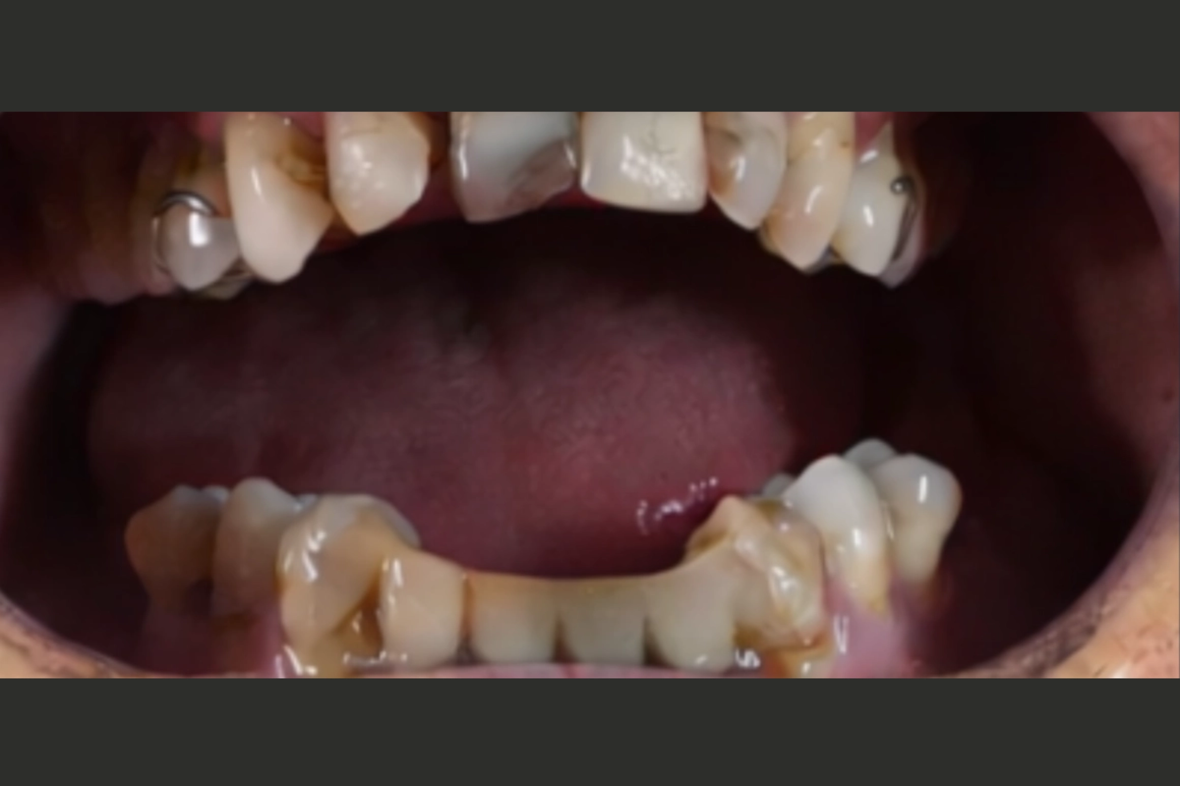 Open mouth showing upper and lower teeth with visible decay and dental damage.
