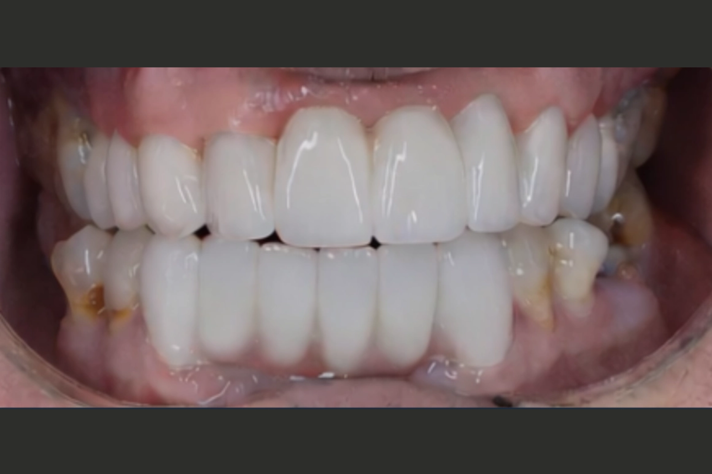 Close-up of a mouth showing upper and lower dental implants with white, aligned teeth.