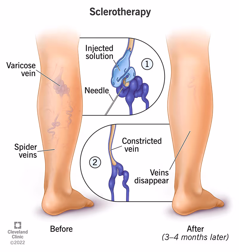 https://my.clevelandclinic.org/-/scassets/images/org/health/articles/6763-sclerotherapy