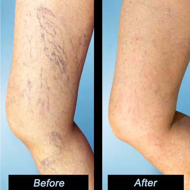 https://tampavascularsurgeon.com/wp-content/uploads/2023/12/Spider-Vein-Specialists-Tampa.jpg