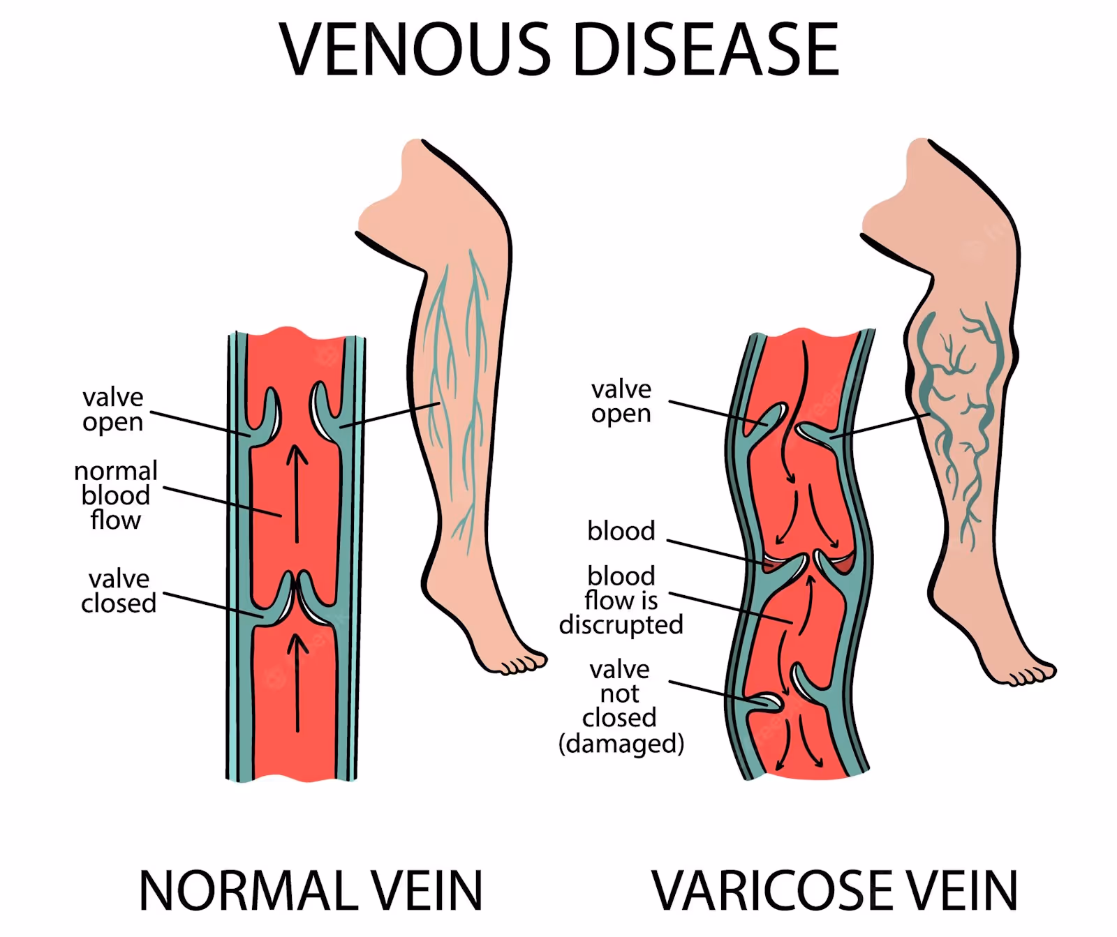 https://assets.milestoneinternet.com/stridecare/site-images/blog/leg-pain-illustration-varicose-veins-venous-disease.jpg