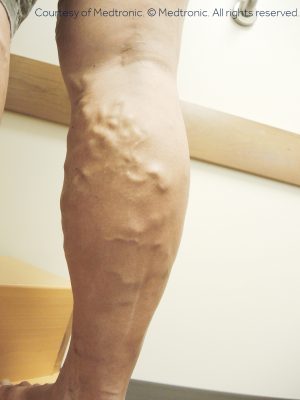 https://www.vipmedicalgroup.com/wp-content/uploads/2019/02/varicose-vein.jpg
