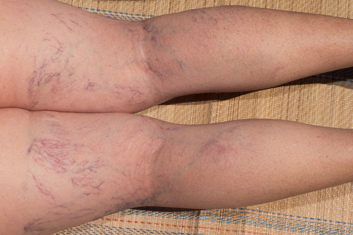 https://www.veinhealth.com.au/wp-content/uploads/2016/11/blog-spiderveins.jpg