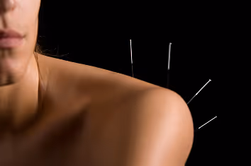 Close-up of a woman's shoulder with acupuncture needles inserted, set against a black background. The image conveys a sense of calm and therapeutic treatment.