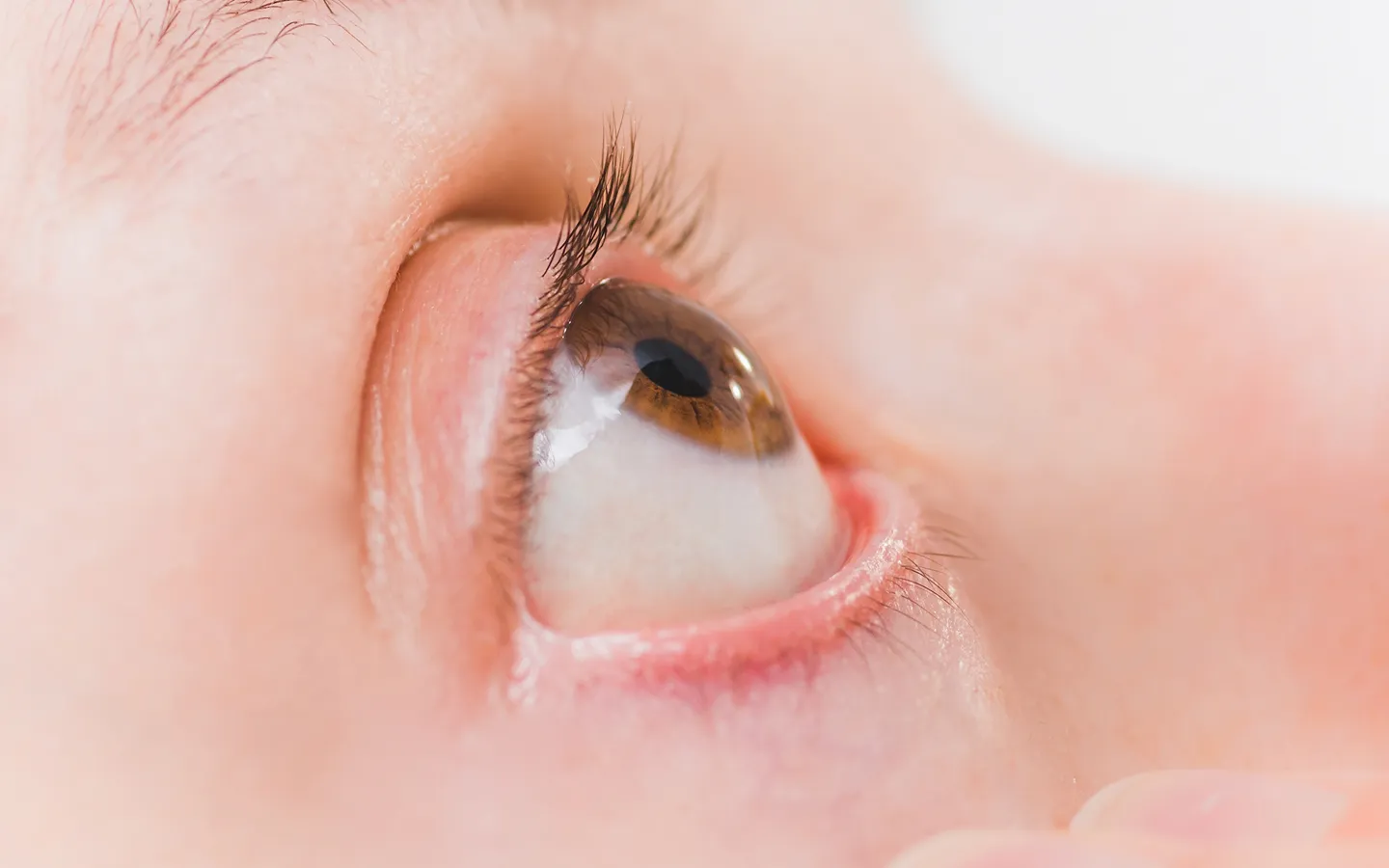 Dry eye condition showing redness and irritation requiring professional eye care treatment