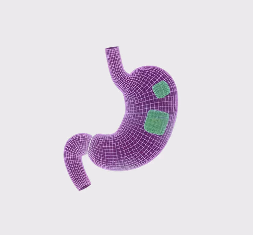 3D wireframe model of a purple stomach with two green highlighted patches on it.