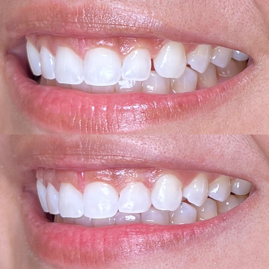 Post-Orthodontic Bonding
