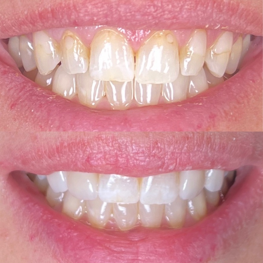 Invisalign & 2 Porcelain Veneers