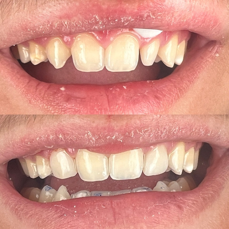 Post-Orthodontic Bonding