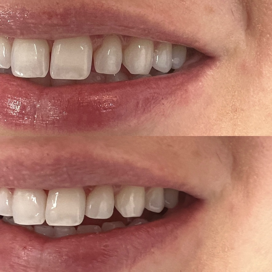 Bioclear Bonding