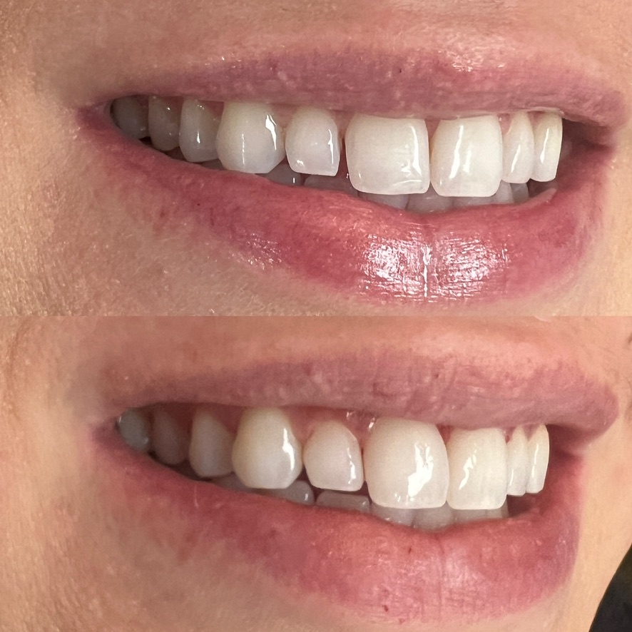 Bioclear Bonding