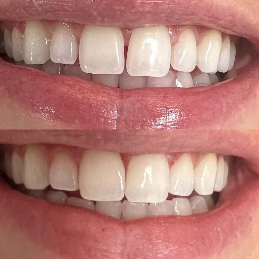 Bioclear Bonding