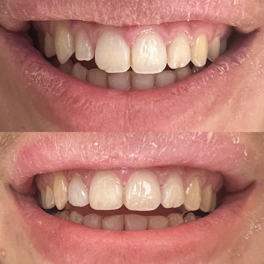 Bioclear Bonding