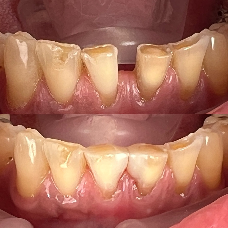 Bioclear Diastema Closure