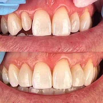 Orthodontics & Bioclear Peg Lateral Bonding