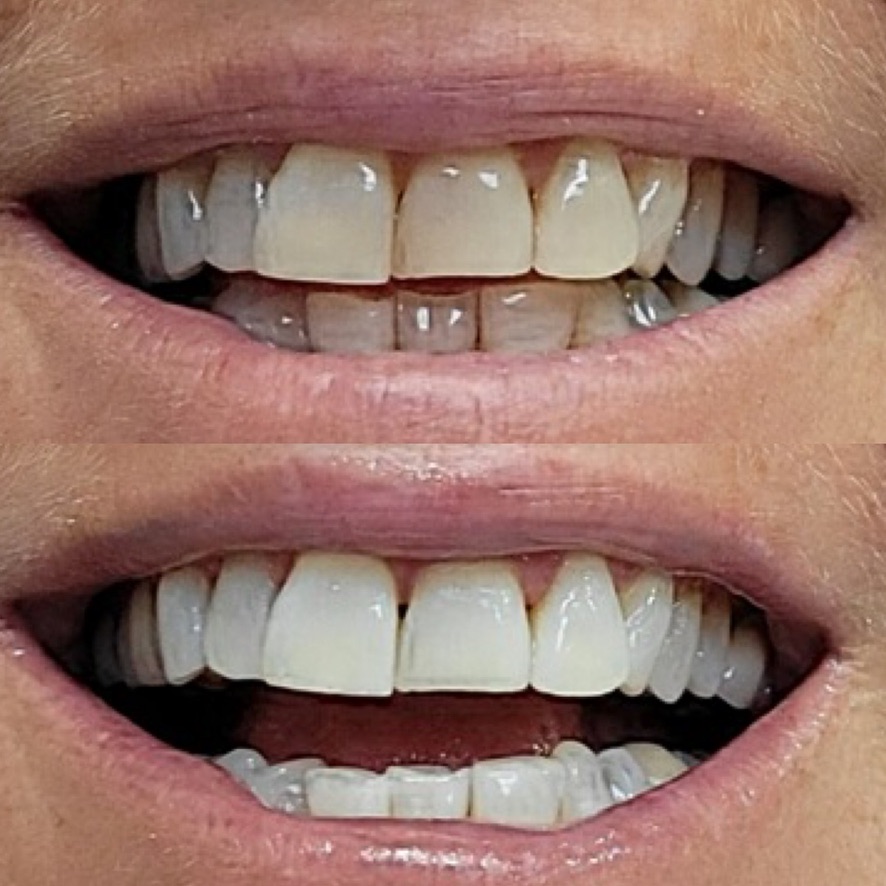 Professional Teeth Bleaching