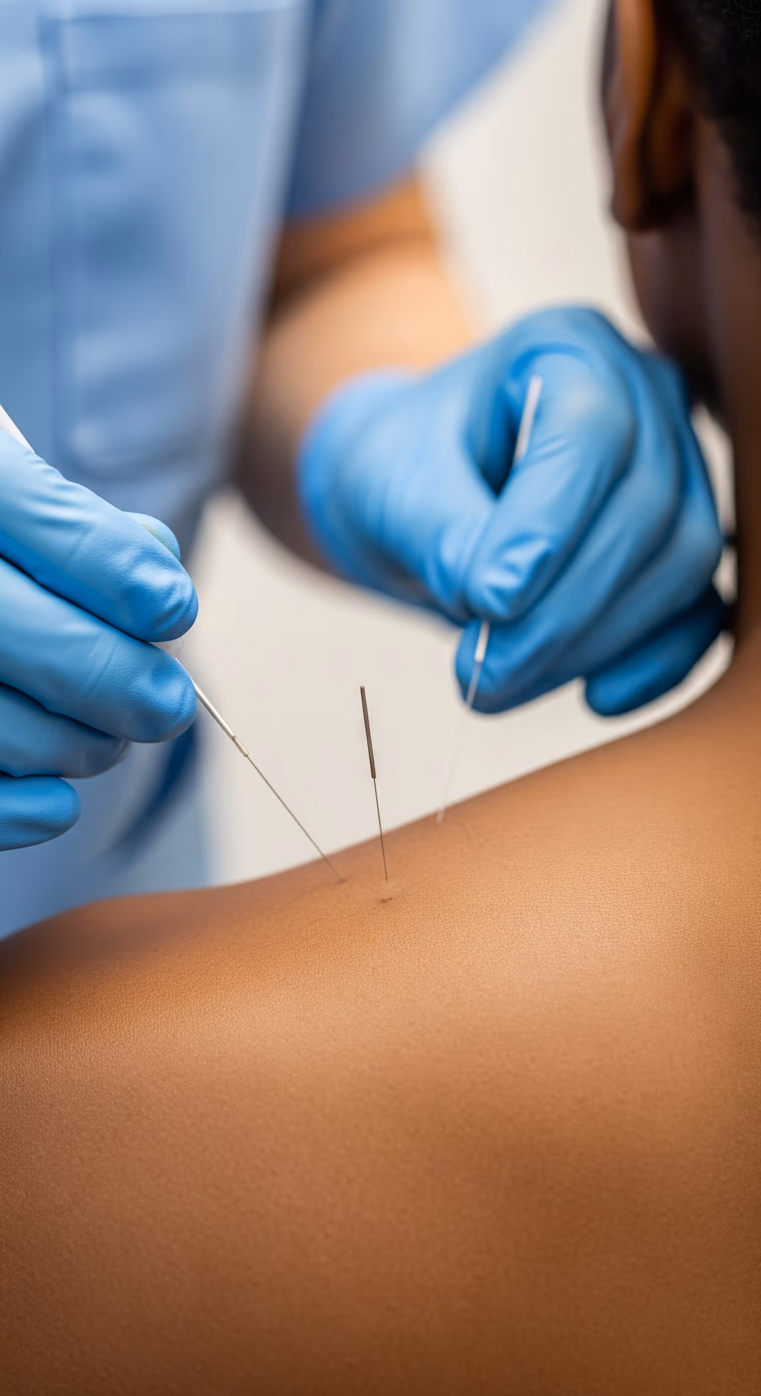 Dry Needling