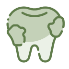Illustration of a tooth with composite bonding material applied on its surface.