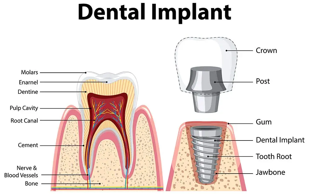 what is a dental implant