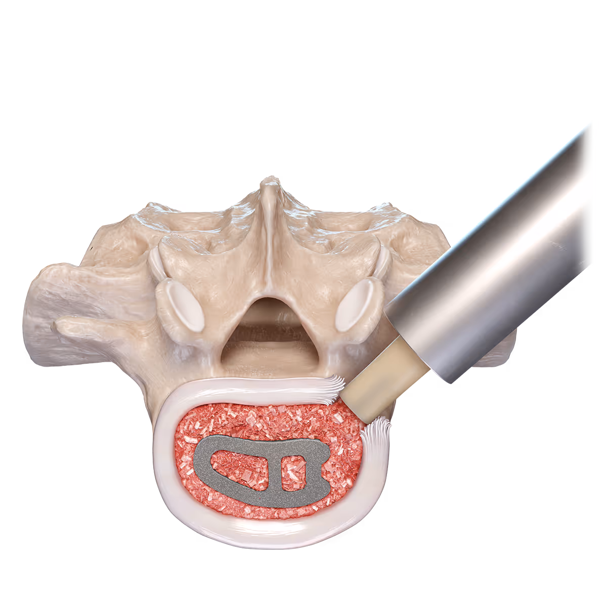Illustration of spinal fusion with implant placement between adjacent vertebrae
