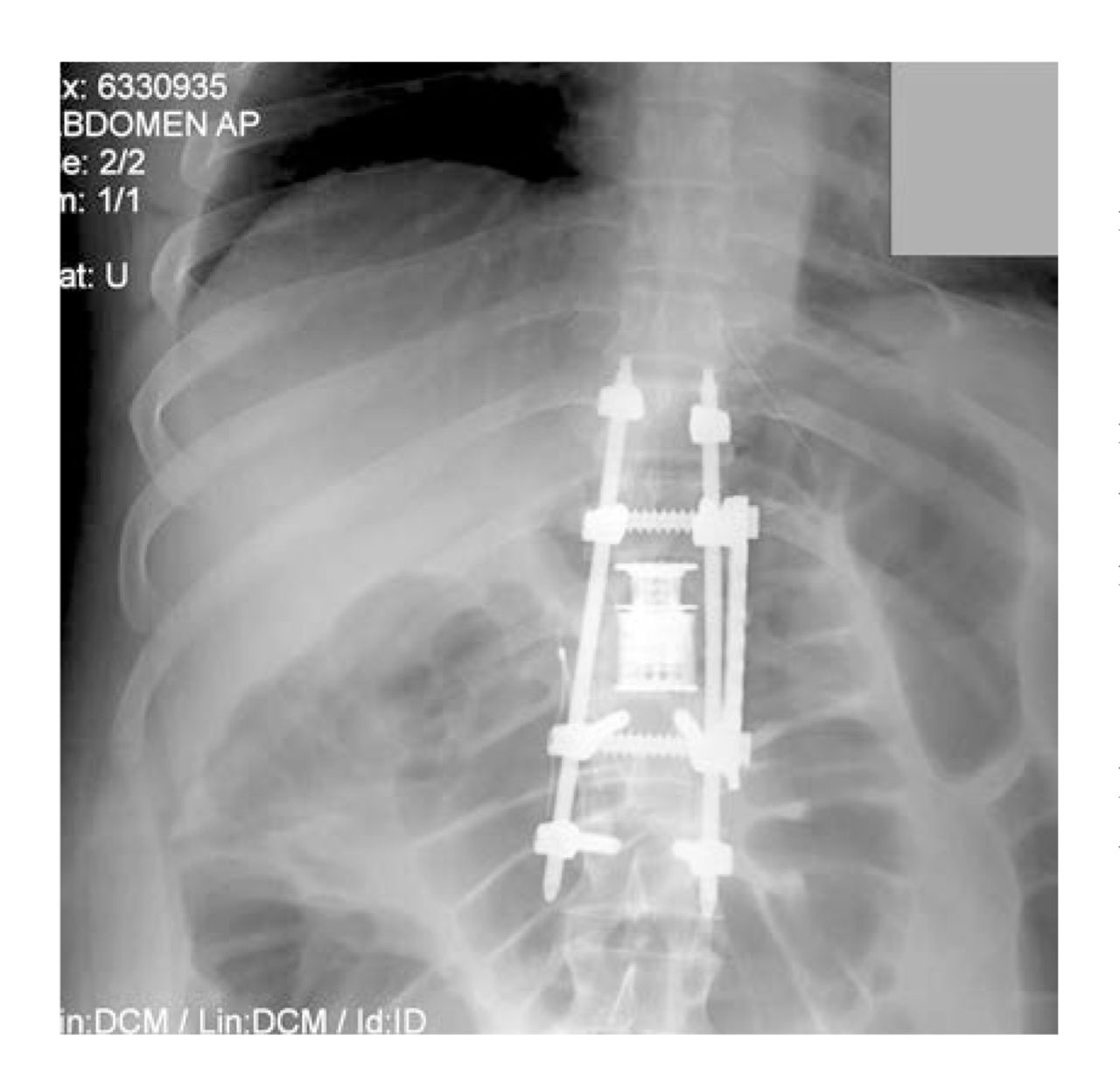 Figure.           Radiologic image of spinal stabilization and fusion in a 36-year-old man with paraplegia and hypogonadism. Hardware was placed from spinal levels T10 through L2. Gonadal innervation classically occurs at spinal levels T10 through T11.25        