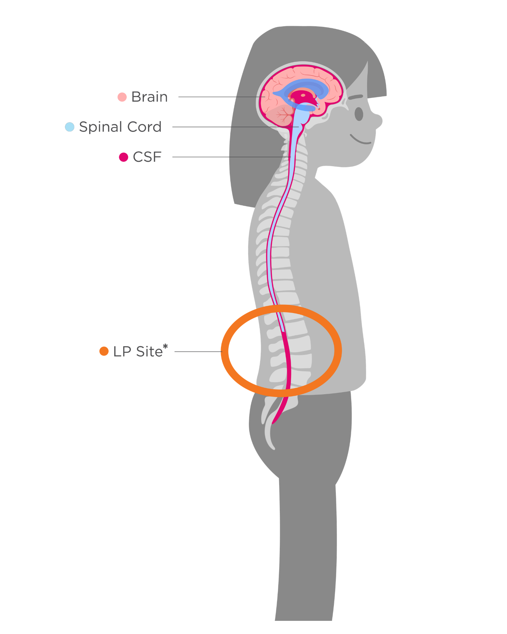 ASCEND study: intrathecal bolus injection