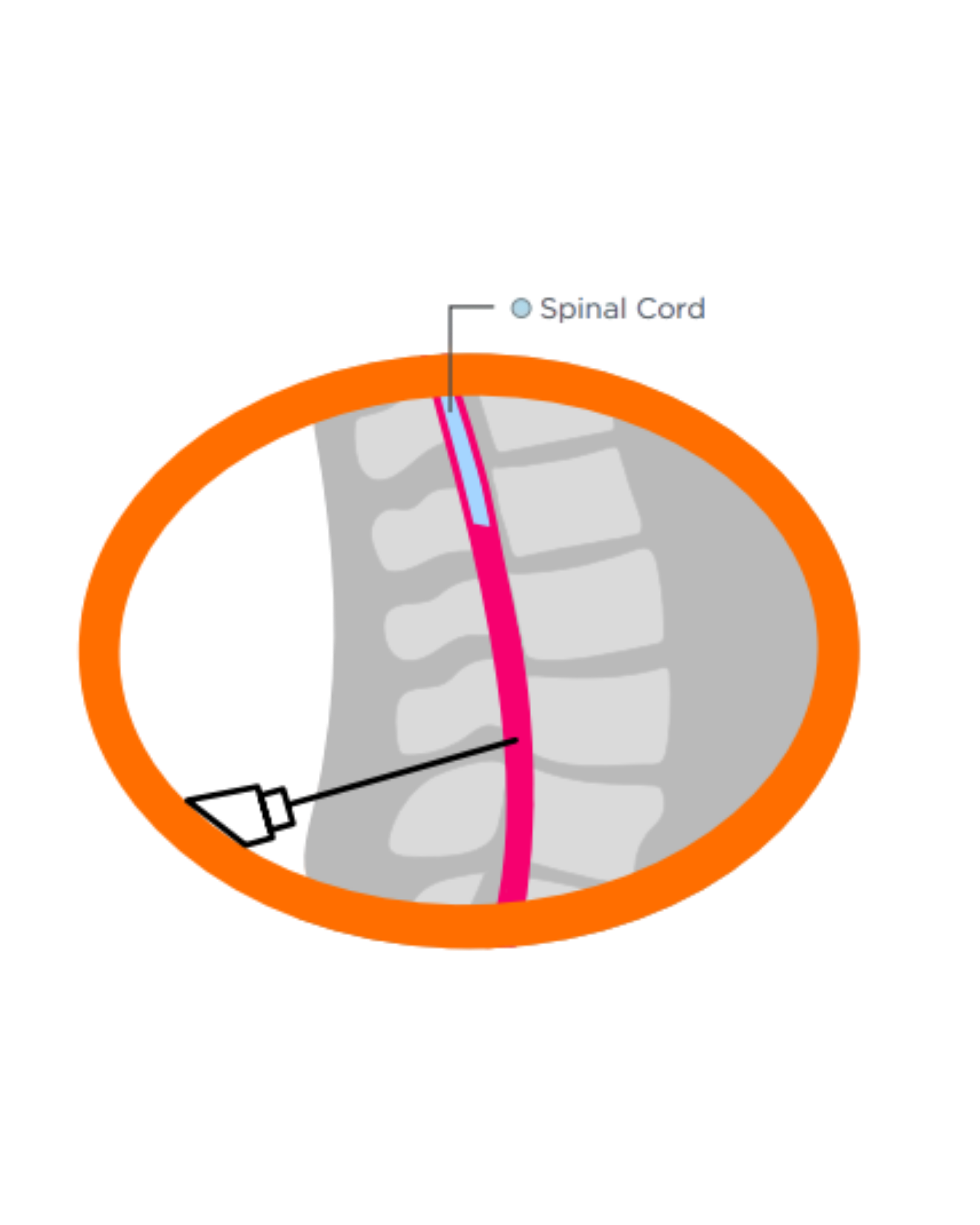ASCEND study: Zoomed view of intrathecal bolus injection lumbar puncture site