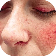 Rosacea