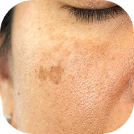 Pigmentation