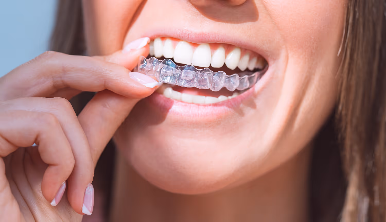 Clear Aligners in Pottstown 
