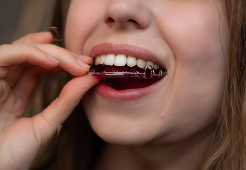 Close-up of a smiling mouth with dental smile design overlay showing tooth alignment and proportions.