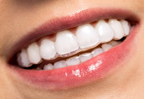Digital 3D dental scan of upper and lower teeth with orthodontic brackets displayed on iTero Element screen.