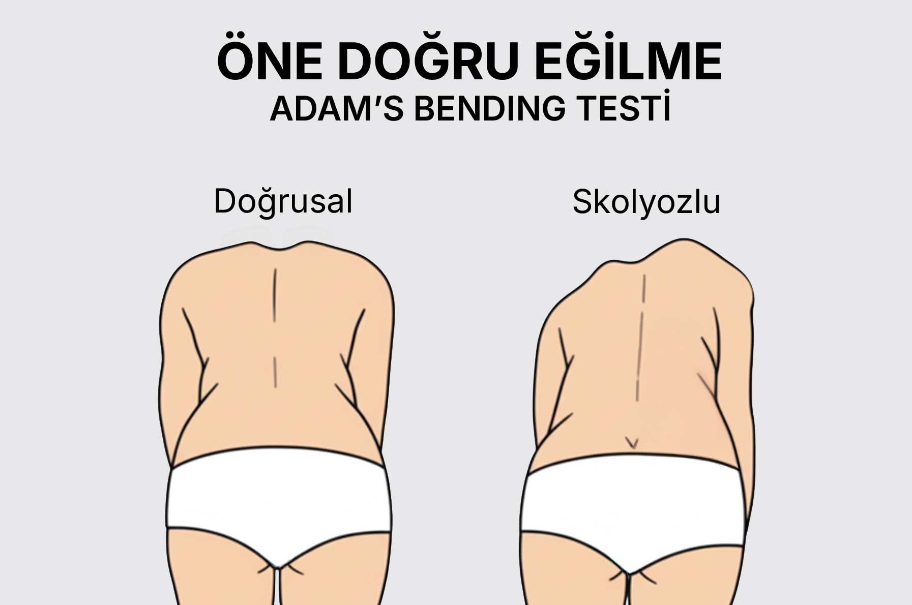 Diagram comparing normal straight back and scoliotic curved back in Adam's bending test with labels 'Doğrusal' and 'Skolyozlu'.