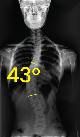Toraks bölgesinde 43 derece açıyla eğri omurga gösteren röntgen görüntüsü.