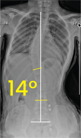 Göğüs bölgesinde 14 derece eğrilik gösteren omurga röntgeni görüntüsü.