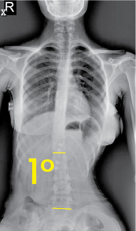 Göğüs ve karın bölgesini içeren, omurgada 1 derece eğrilik gösteren frontal X-ışını görüntüsü.