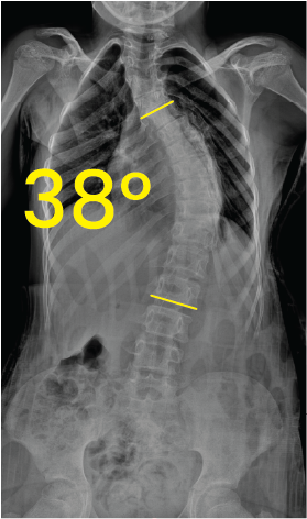 X-ray image of a spine showing scoliosis with a 38-degree curvature marked between two yellow lines.