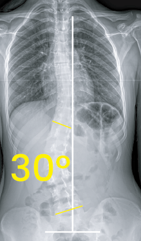 Toraks röntgen görüntüsünde 30 derecelik skolyoz eğriliği sarı açılarla ve beyaz çizgilerle işaretlenmiş.