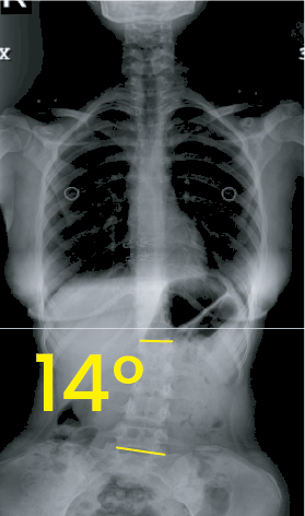 Göğüs bölgesinde 14 derece eğrilik gösteren omurga röntgeni görüntüsü.