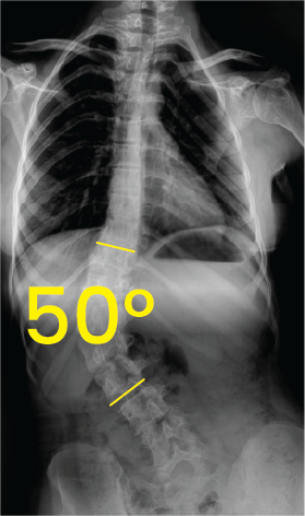 Göğüs ve bel omurgasını gösteren röntgen görüntüsü, omurga eğrilik açısı 50 derece olarak işaretlenmiş.