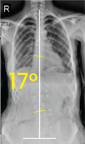 Göğüs bölgesinde 17 derece eğiklik gösteren omurga röntgeni görüntüsü.