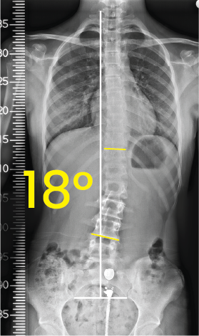 Toraks ve karın bölgesinin X-ray görüntüsü, omurga 18 derece lateral skolyoz ile hafif eğrilmiş.