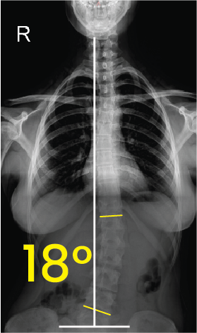 Torakal omurgada sağa doğru 18 derece eğriliği gösteren röntgen görüntüsü.