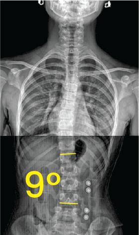 Göğüs ve karın bölgesinin röntgeni üzerinde, omurga eğriliğini vurgulayan 9 derece açıyla işaretlenmiş omurga escoliosis görüntüsü.