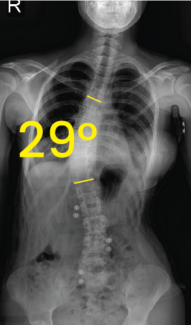 Göğüs ve lomber omurgada 29 derece skolyoz eğrisi gösteren röntgen görüntüsü.