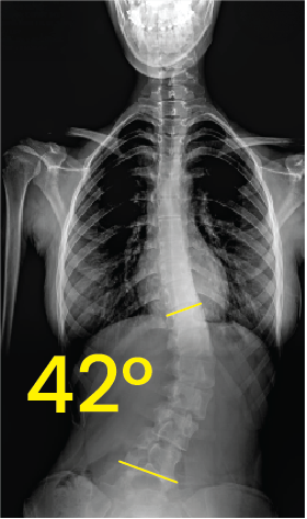 Göğüs ve belde 42 derece eğriliği gösteren omurga röntgeni görüntüsü.