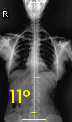 Toraks röntgeninde orta çizgiye göre 11 derece eğimli omurga görünümü.