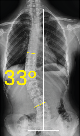 Bel omurgasında 33 derecelik eğrilik gösteren skolyozlu insan göğüs ve karın röntgeni.